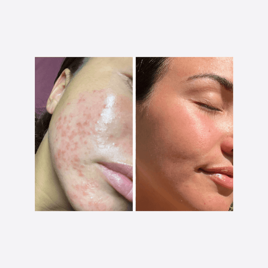 National Acne Awareness Month