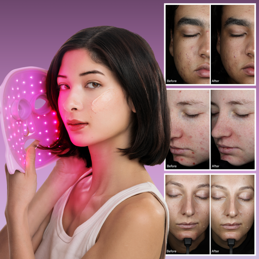 Exploring Pro-Approved Acne Care and The Latest Omnilux Clear Clinical Study Results