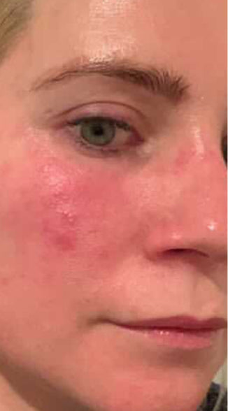 Face with acne and redness before using Omnilux mask