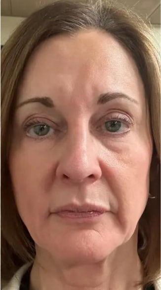 Face with reduced wrinkles after using Omnilux mask