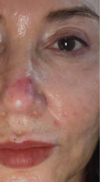 Acne, redness, wrinkles before using the Omnilux Contour Face mask