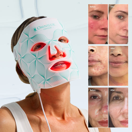 Inside the Omnilux Contour Face Clinical Study: What Research Reveals