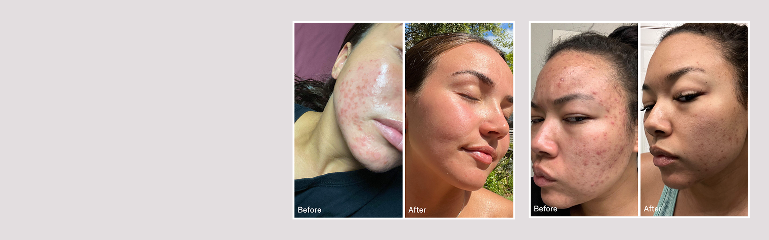 National Acne Awareness Month