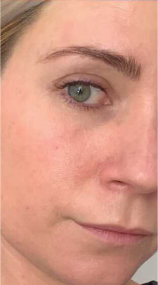 Face without acne and redness after using Omnilux mask