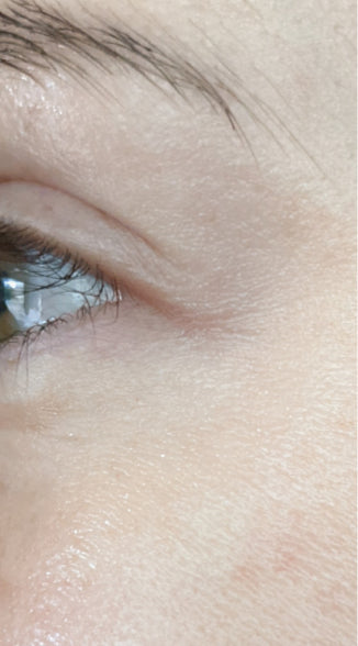 Reduced wrinkles around the eyes after using the LED device