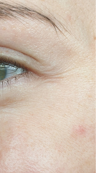 Wrinkles around the eyes before using the LED device