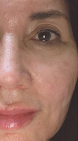 Huge skin improvements after using the Omnilux Contour Face mask